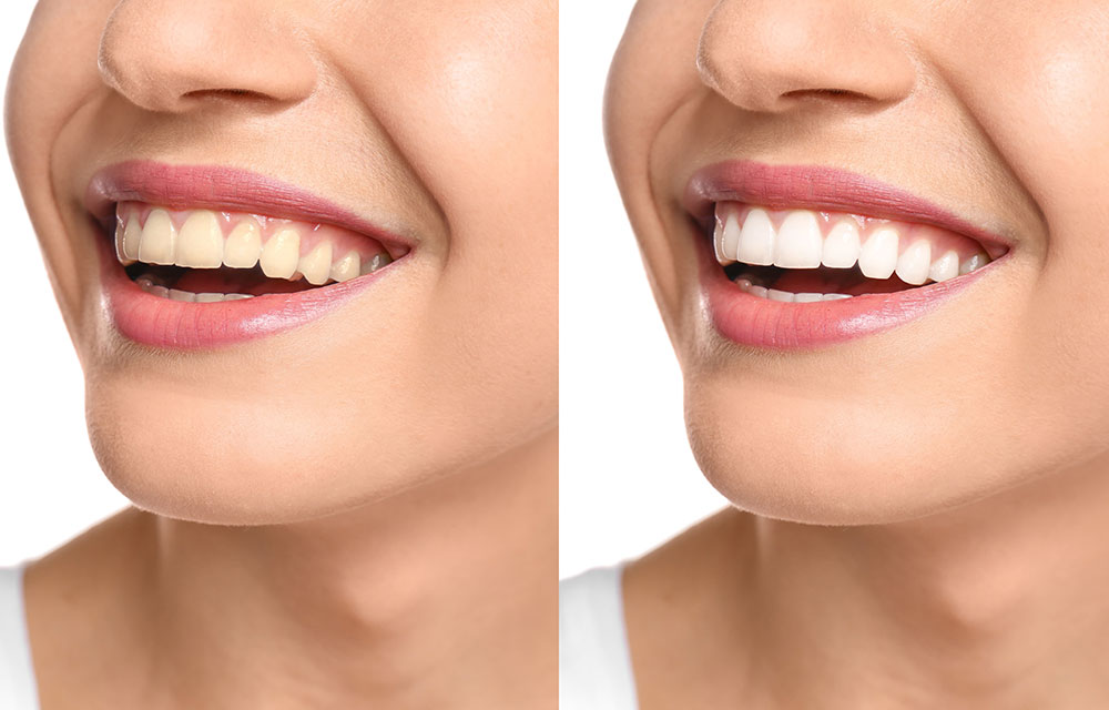 歯の白さで与える印象は大きく変わる