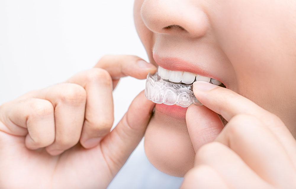 ご自宅で行うホームホワイトニング