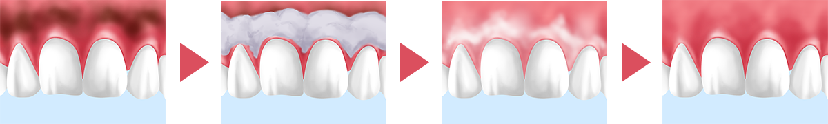 歯ぐきの黒ずみも除去できる