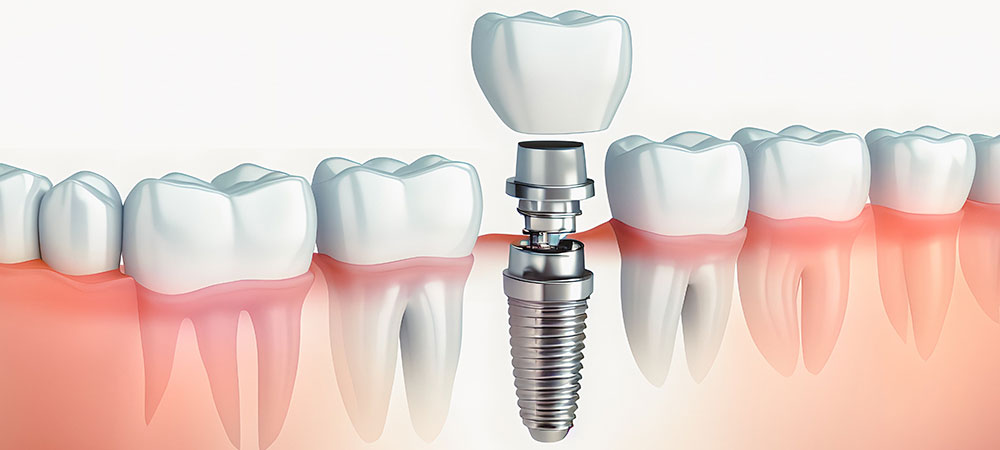 周りの歯に負担をかけないインプラント