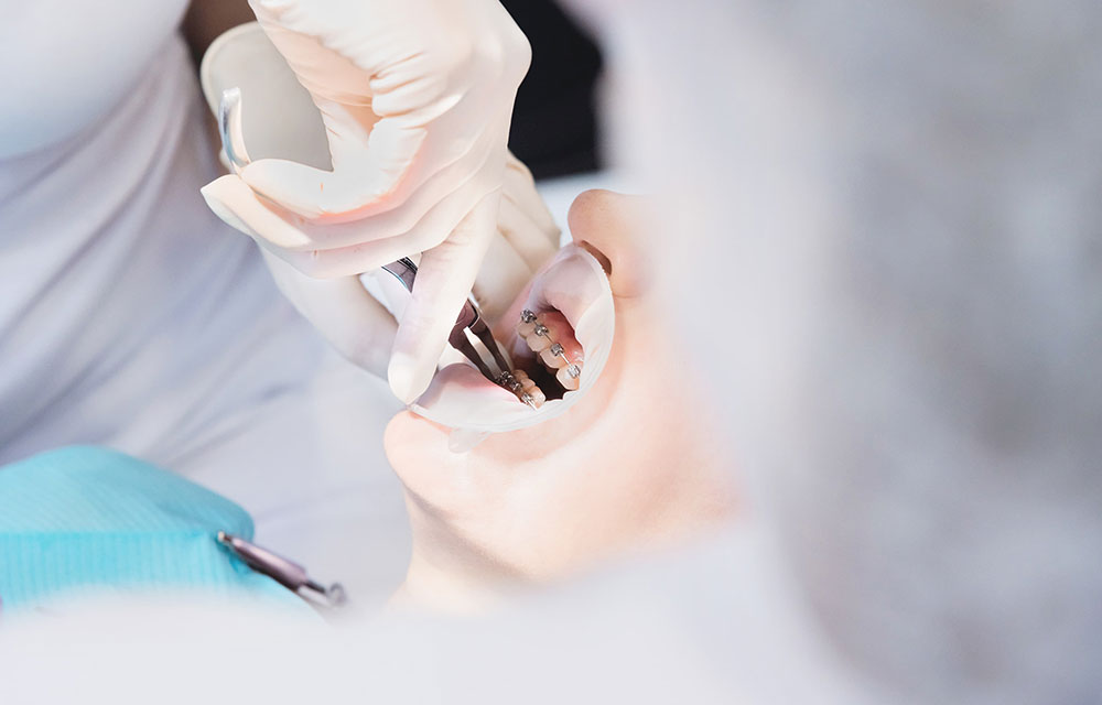 保定装置の製作・装置の除去