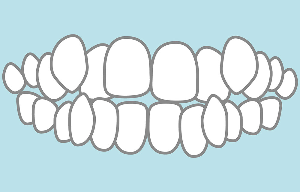歯の重なり度合い（叢生：そうせい）
