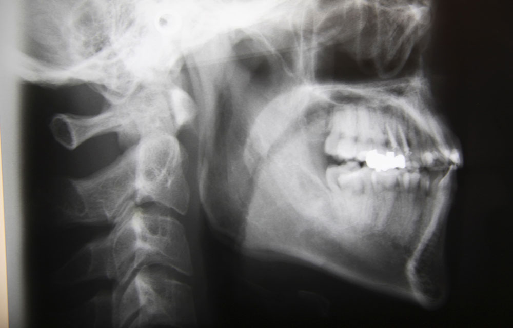 セファログラムによる分析