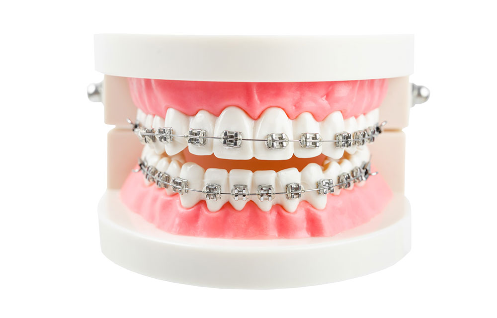 メタルブラケット