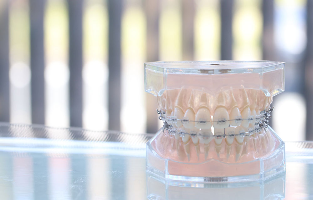 クリアブラケット