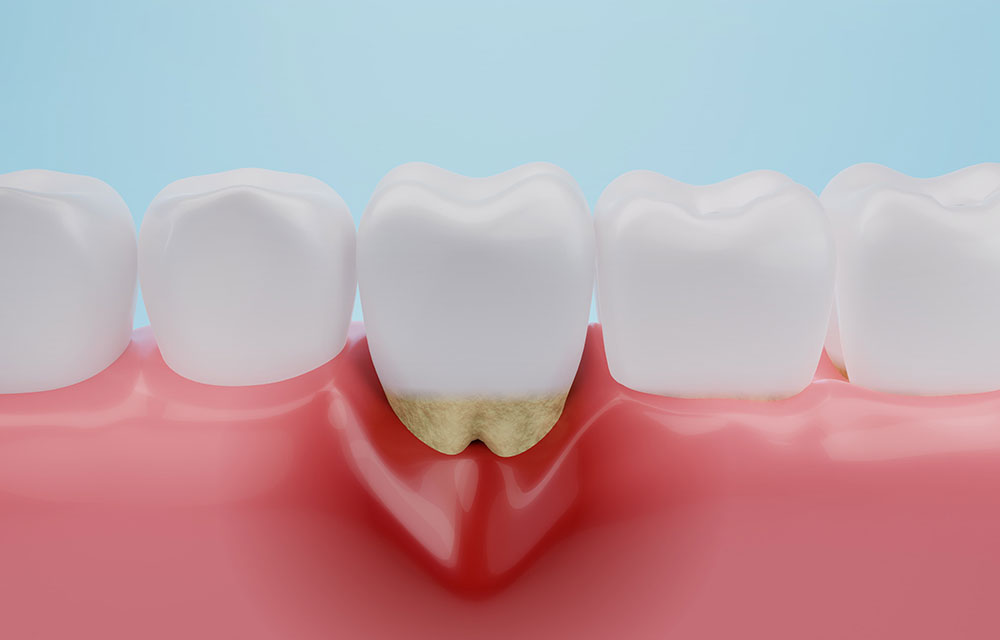 日本人の5人中4人は歯周病です