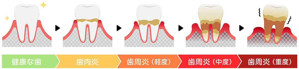 なぜ歯周病になるのか？