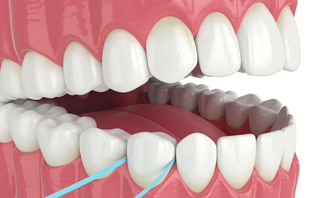 プラークコントロール