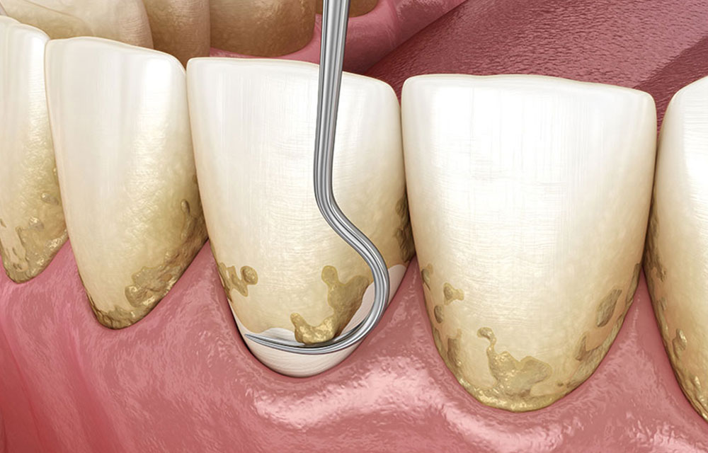 スケーリング・ルートプレーニング