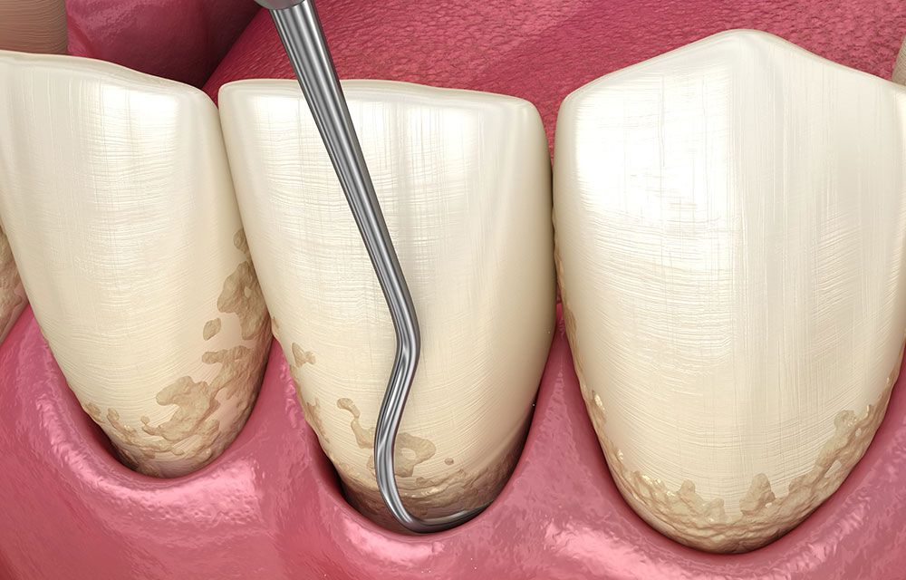 歯周ポケット掻爬術